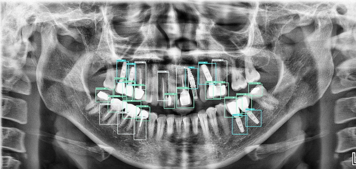 Dişlerin ve Diş Problemlerinin Tespit Edilmesi